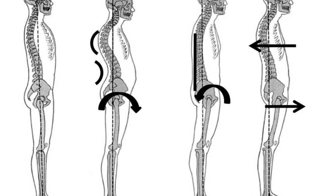 Поясничный лордоз сглажен. Лордоз шейного отдела отдела. Лордоз поясничного отдела позвоночника норма. Лордоз поясничного отдела позвоночника причины. Физиологический лордоз выпрямлен.
