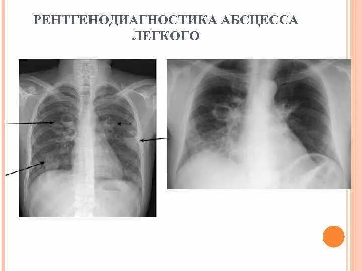 После абсцесса легкого. Абсцесс легкого 1 стадия рентген. Рентгенография при абсцессе легкого. Абсцесс легкого рентген. Рентгенограмма при абсцессе легкого.