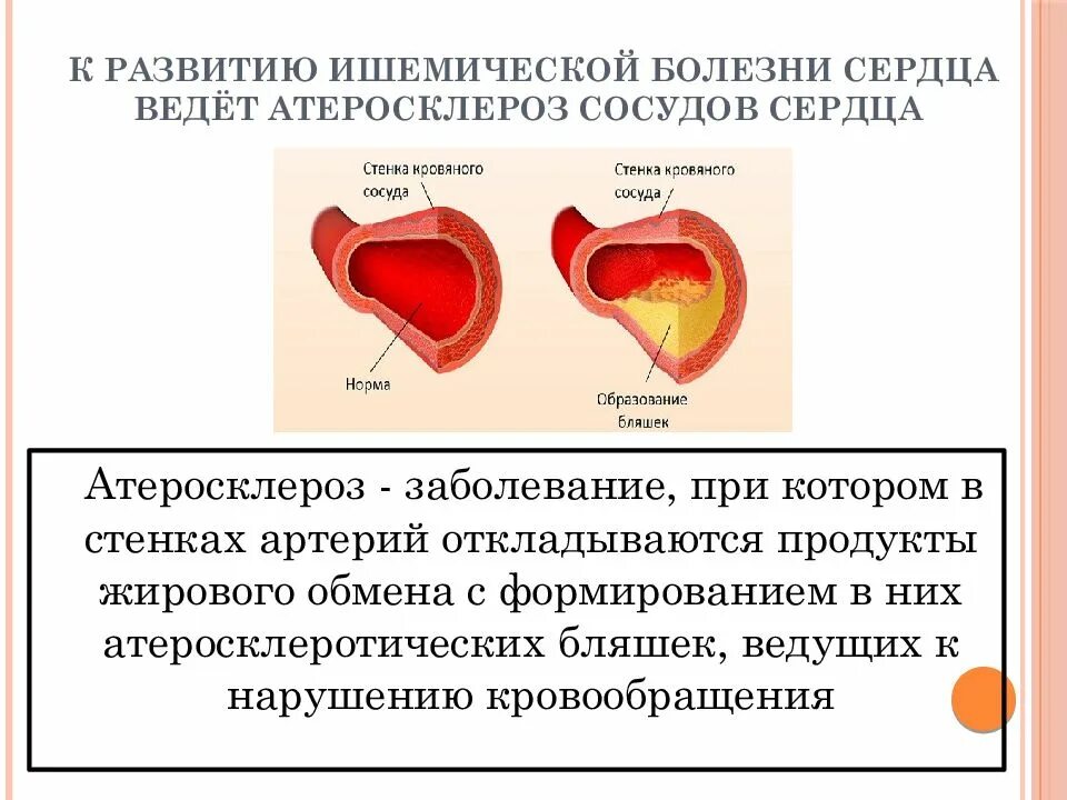 Ишемия сосудов симптомы. Атеросклеротическая болезнь болезнь сердца. Симптомы атеросклеротического поражения сосудов миокарда. Ишемическая болезнь сердца симптомы. Факторы вызывающие ишемическую болезнь сердца.