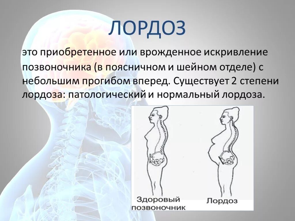 Усиленный лордоз. Физиологический поясничный лордоз сглажен что это. Лордоз поясничный 2 степени. Патологический лордоз поясничного отдела. Изгиб в поясничном отделе позвоночника это.