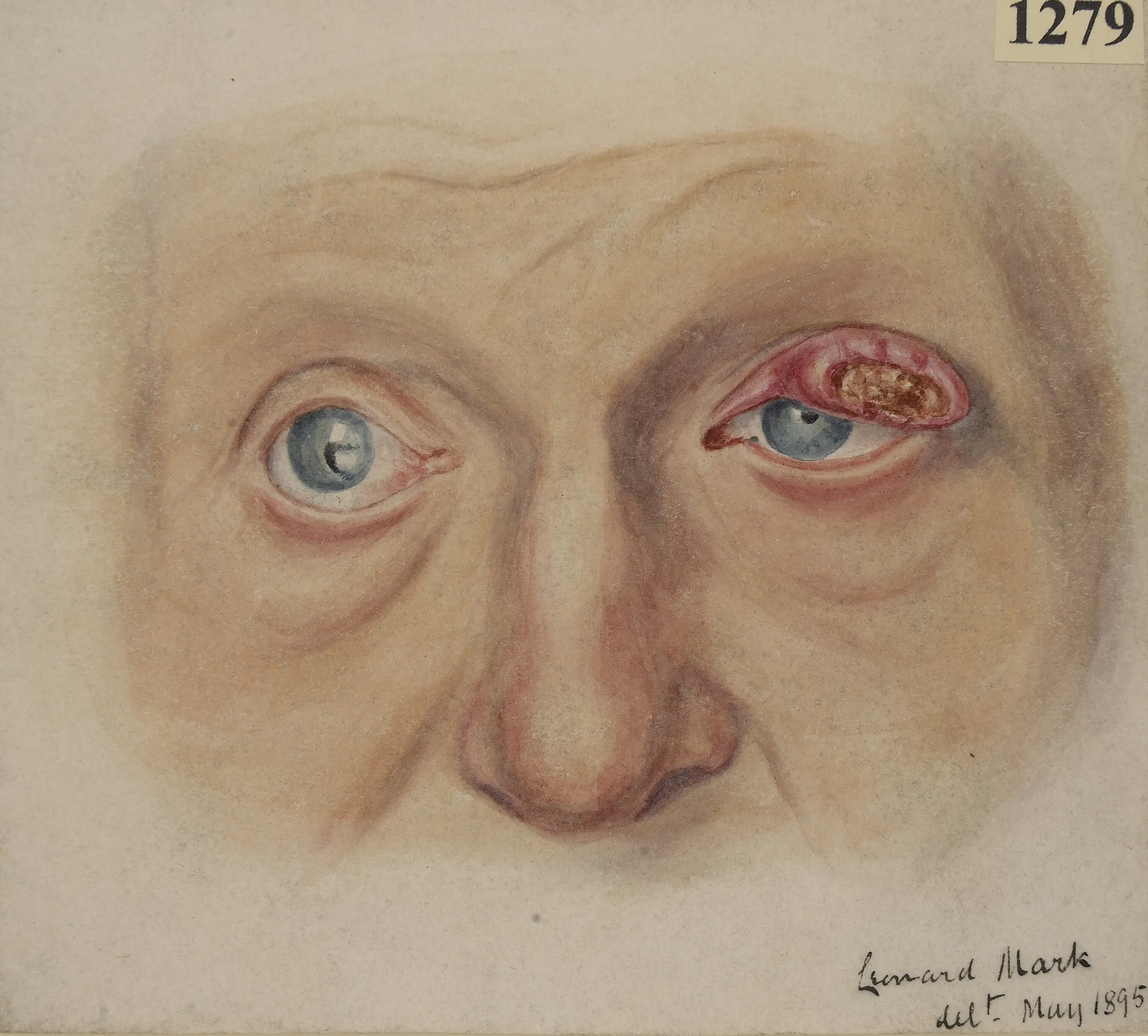 File:Bowen disease (4).jpg - Wikipedia