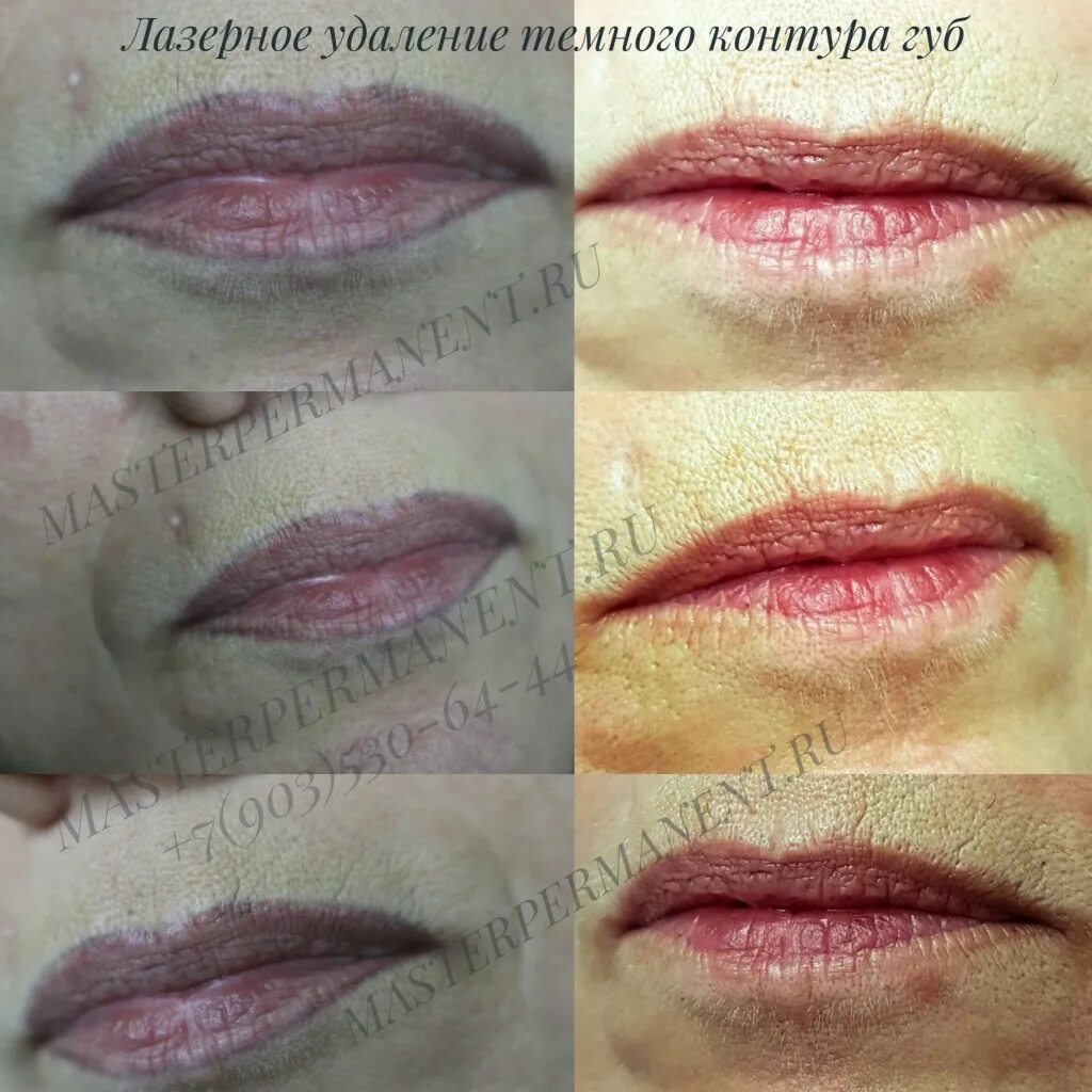 Губы после удаления лазером. Перманентный макияж губ. Удаление перманента губ лазером. Татуаж губ. Перманентный макияж губ.