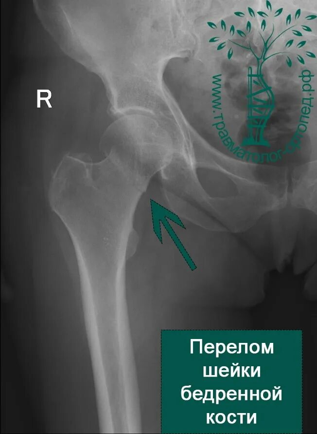 Сколько заживает бедро. Вертлужный перелом шейки бедра. Перелом шейки бедра клиника.