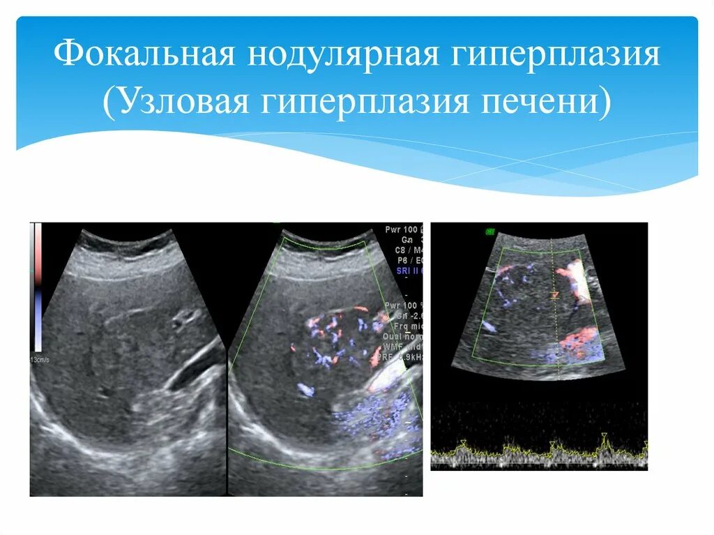 Узловая гиперплазия печени. Нодулярная Узловая гиперплазия печени. Фокальная Узловая гиперплазия печени на УЗИ. Фокальная нодулярная гиперплазия печени. Фибронодулярная гиперплазия.