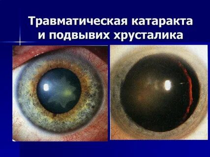 Симптомы вторичной катаракты после замены