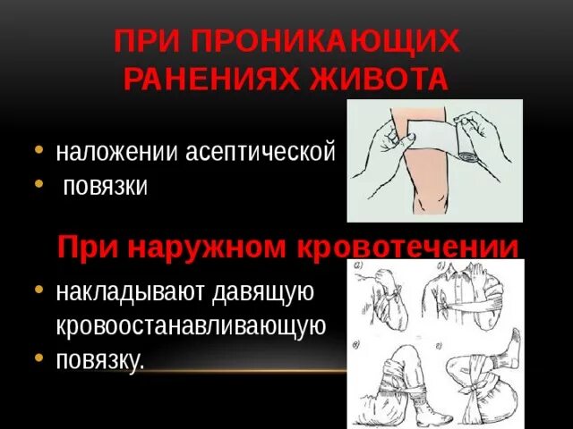 При кровотечении накладывают повязку. Наложение асептической повязки. наложение повязки при кровотечении. накладывается стерильная повязка. наложение антисептической повязки алгоритм.