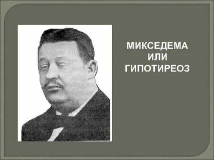 Микседема при гипотиреозе