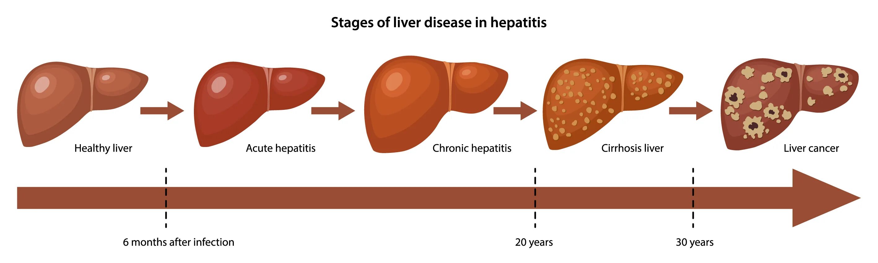 Стадии гепатита б. Цирроз печени гепатит b. Печень здоровая и больная. Этапы поражения печени.