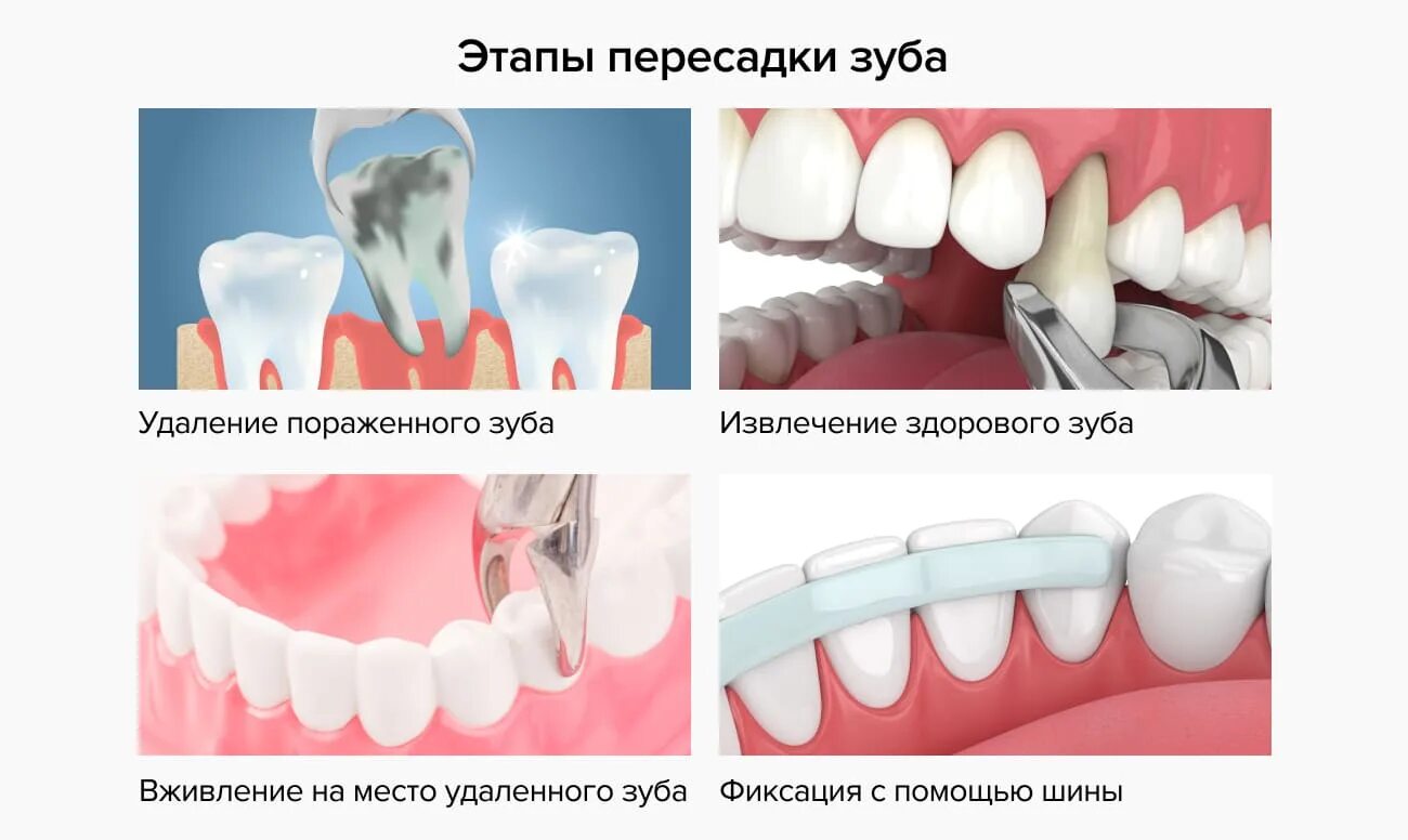 Какие зубы удаляют