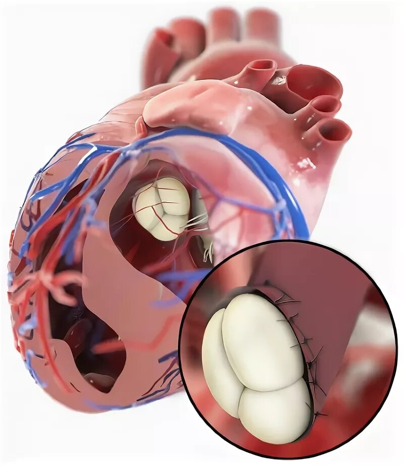 Инвалидность после замены клапана. Искусственный митральный клапан. Механический митральный клапан сердца. Искусственный митральный клапан сердца. Искусственный аортальный клапан сердца.