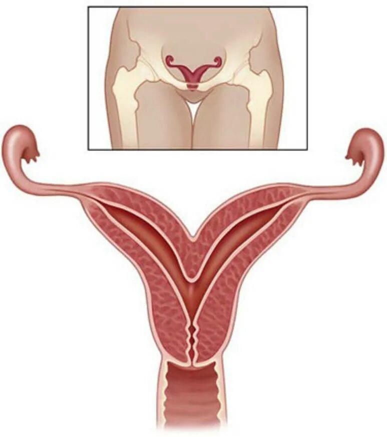 Двурогая матка и беременность. Двурогая седловидная матка. Двурогая седловидная матка. Двурогая матка у женщин. Двурогая матка и беременность.