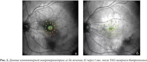 Витреолизис цена. Деструкция витреолизис. Yag-лазерный витреолизис.