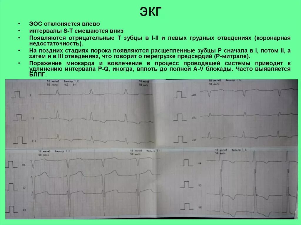 Отрицательный зубец р на ЭКГ В v1 v2. Отрицательный зубец т на ЭКГ В отведениях v1-3. Отрицательный зубец т на ЭКГ В грудных отведениях v1 v2. Отрицательный зубец т в 1 отведении. Низкоамплитудная экг что это значит