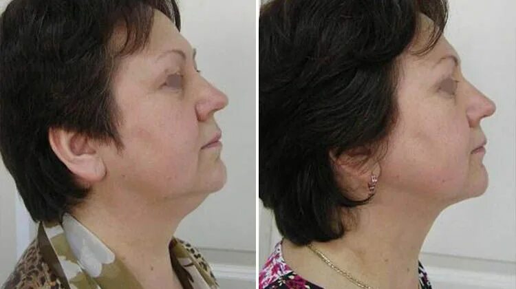 Liposuction Before and After: Neck Liposuction by Body Areas: Before and After P