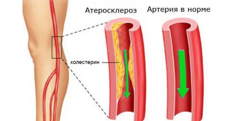 Артерий атеросклероз латынь. Облитерирующий атеросклероз артерий нижних конечностей. Облитерирующий атеросклероз сосудов конечностей. Облитерация сосудов нижних конечностей. Облитерирующий атеросклероз артерий нижних конечностей симптомы.