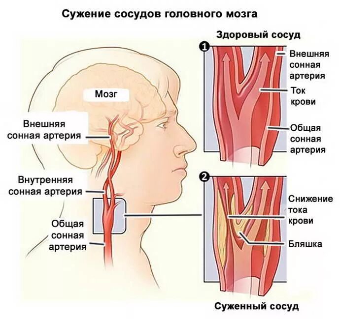 Помочь сосудам головы. Сужение сосудов головного мозга. Общая Сонная артерия. Стеноз внутренней сонной артерии.