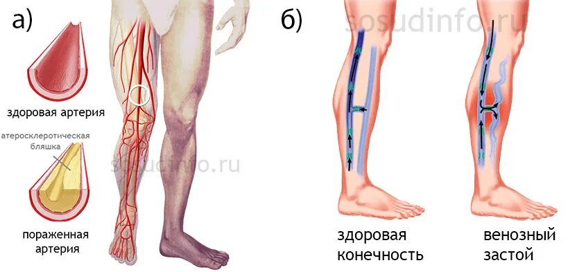 Венозный застой крови