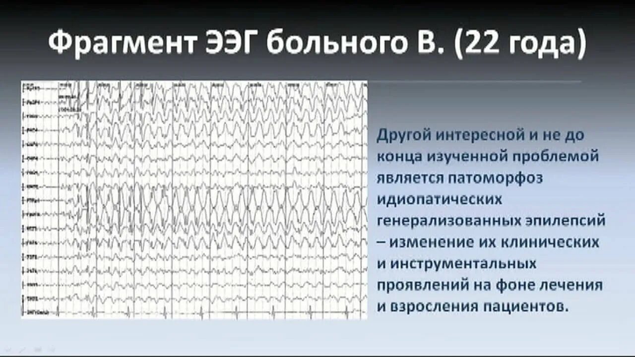 Низкоамплитудная ээг. Генерализованная эпилепсия ЭЭГ. ЭЭГ при эпилепсии. Заключение ЭЭГ при эпилепсии. ЭЭГ здорового человека.