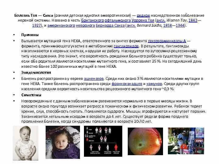 Синдром тея сакса. Наследование тея-сакса. генетическая болезнь тея-сакса.