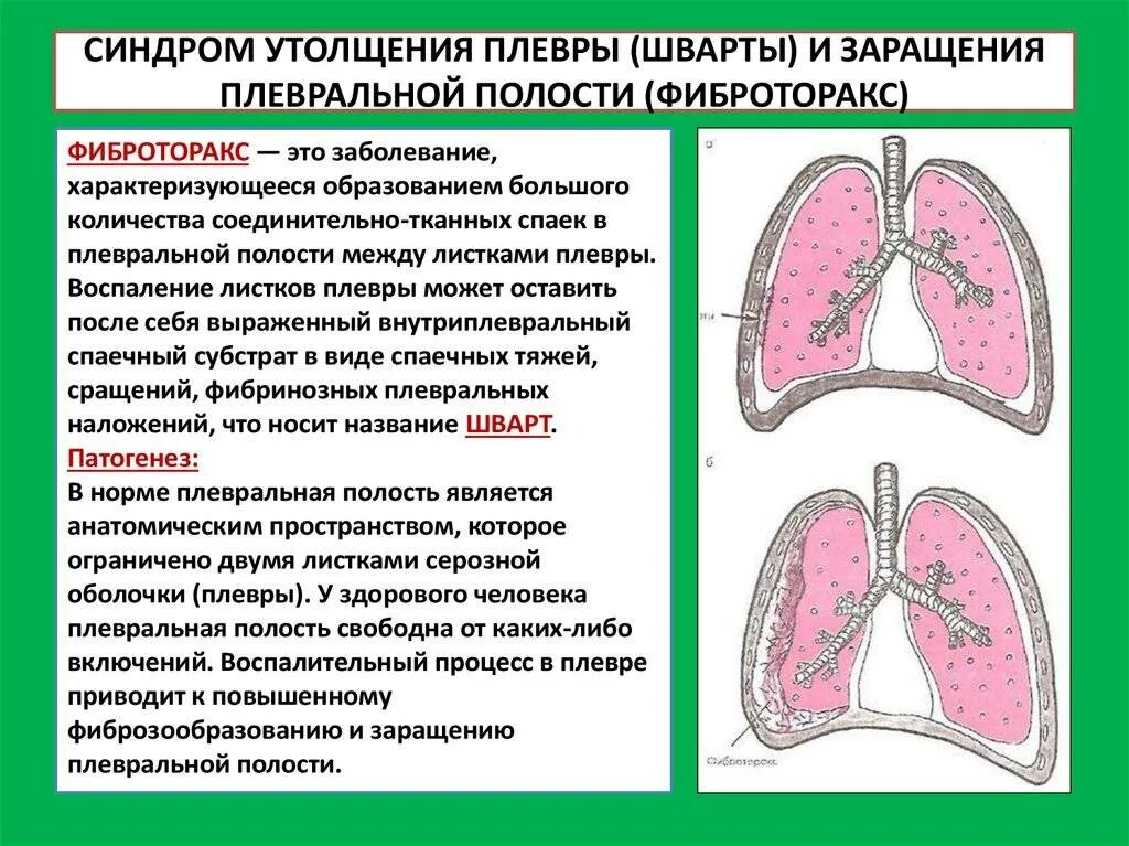 Плеврит лечение у пожилых