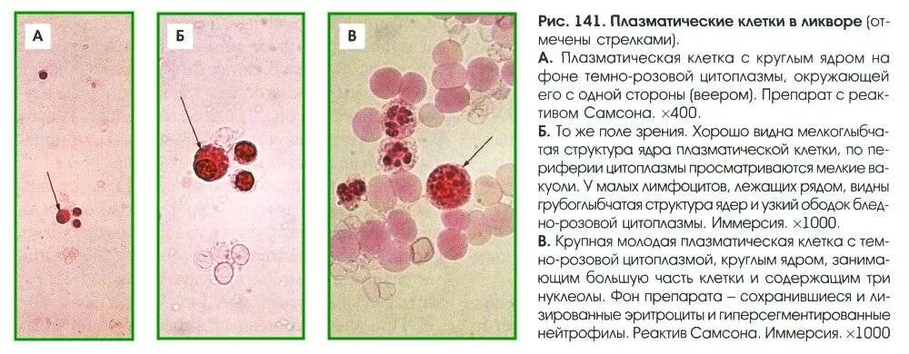 Лимфоциты цитология. Исследование спинномозговой жидкости лимфоциты. Нейтрофилы в ликворе клетки. Цитология ликвора микроскопия. Патологические клетки крови не обнаружены