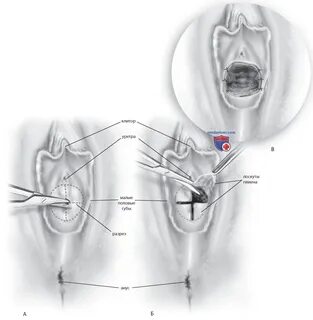 Операция при атрезии девственной плевы (гимена): техника, этапы