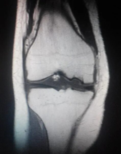 Остеохондрит коленного сустава мрт. Рассекающий остеохондрит надколенника рентген. Болезнь Кёнига рассекающий остеохондрит. Болезнь Кёнига рассекающий остеохондрит мрт.