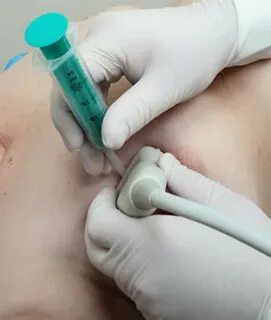 Где сдать пункцию