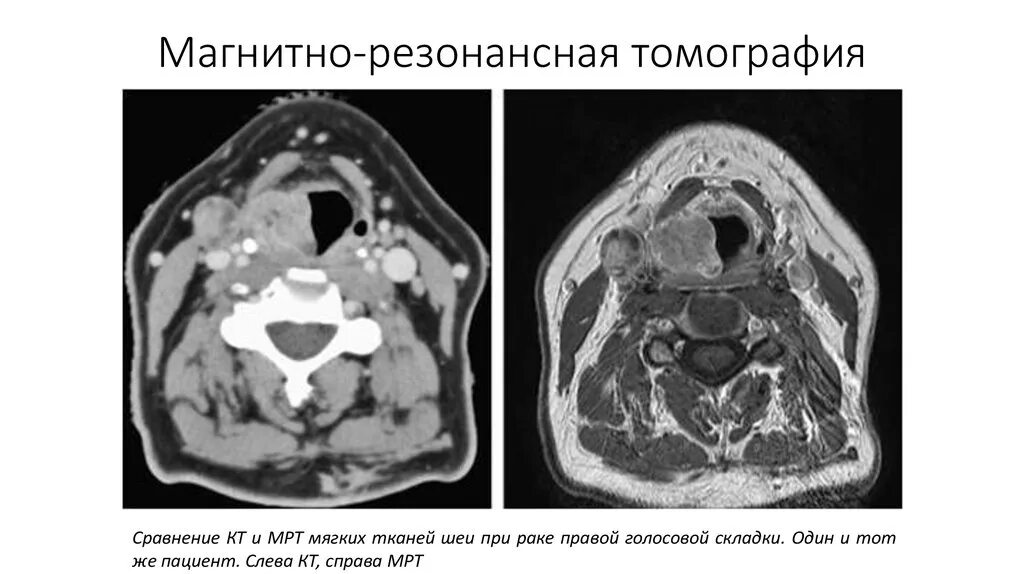 Анатомия ротоглотки мрт. Мрт мягких тканей гортани. Опухоль гортани кт картина. Кт миндалин