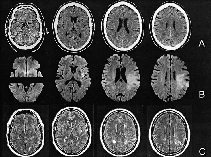 Мрт головного мозга и сосудов тула. Афазия мрт. мрт головы с контрастом. aphasia mri. ct scan image.
