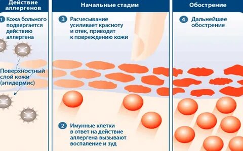 Виды аллергического дерматита