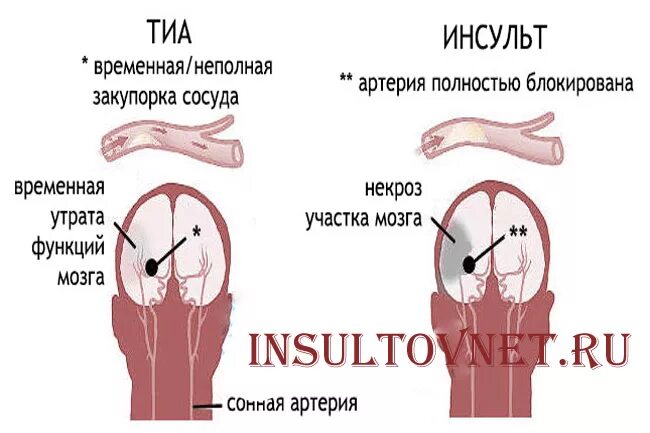 Инсульт различия. Транзиторная ишемическая атака отличие от инсульта. Ишемическая атака или инсульт разница. Транзиторно ишемический инсульт. Транзиторные ишемические атаки.