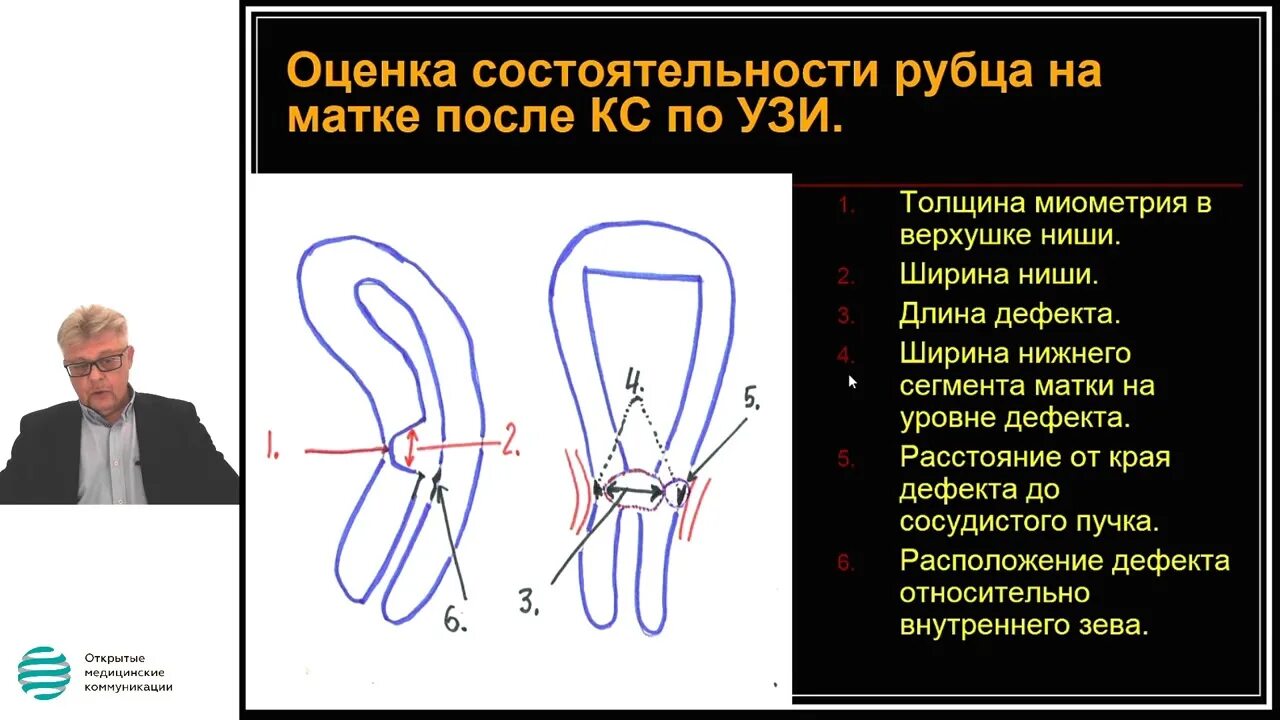 Узи шов кесарево. Рубец на матке после КС на УЗИ. Оценка состоятельности рубца на матке. Несостоятельность рубца. Несостоятельность рубца УЗИ.