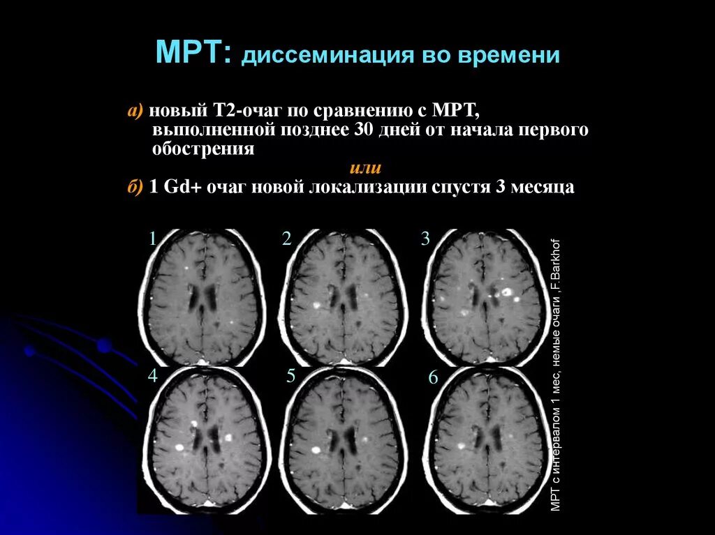 Сосудистый очаг в головном мозге что это. Рассеянный склероз и ОРЭМ мрт. Рассеянный склероз мозжечок мрт. Мрт мозга рассеянный склероз. Мрт рассеянный склероз спинной мозг.