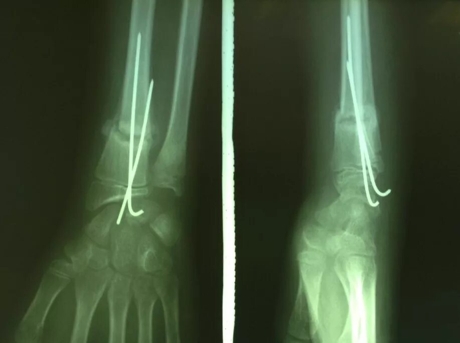 перелом со смещением ставят спицу. перелом со смещением ставят спицу. перелом костей предплечья остеосинтез пластинами. остеосинтез шейки плеча рентген. перелом со смещением ставят спицу.