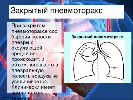 Понятие пневмоторакса