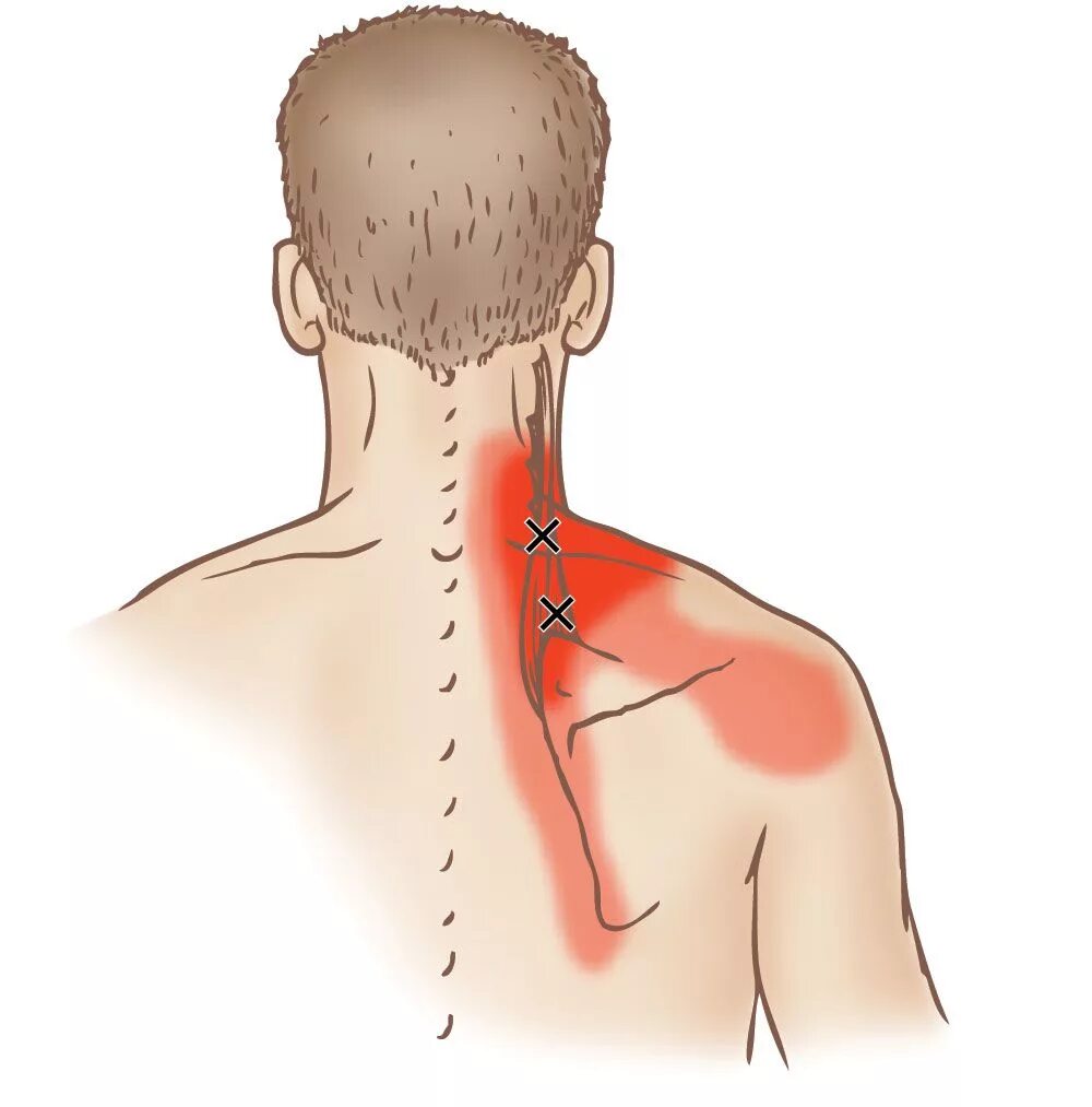 Болят плечи отдает в голову. Ременная мышца шеи триггерные точки. Триггерные точки шейного отдела позвоночника. Мышца поднимающая лопатку триггерные точки.