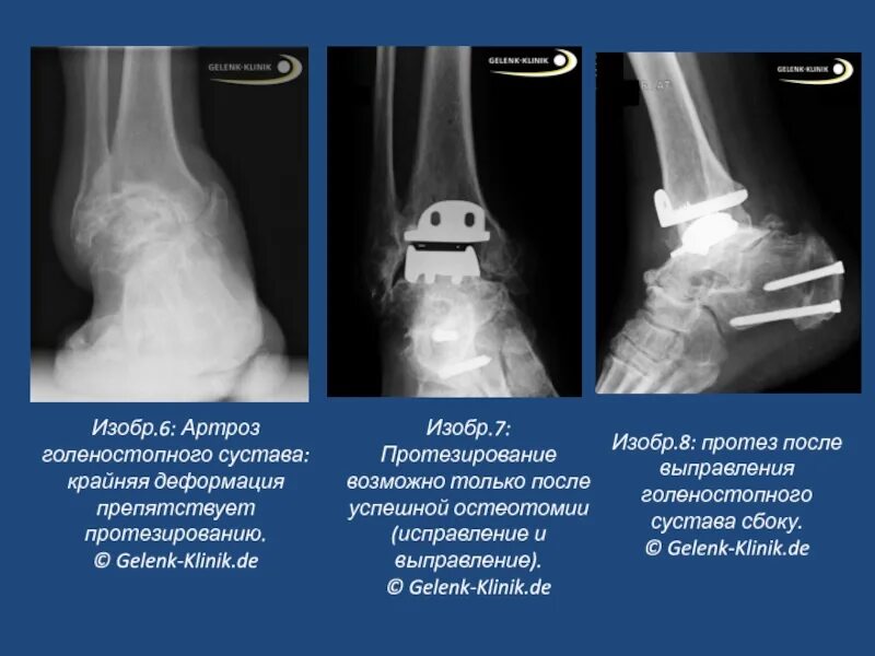 Артроз деформация суставов. Стадии артроза голеностопного сустава рентген. артроз голеностопного сустава 3 степени рентген. анкилоз сустава голеностопного сустава. артроз голеностопного сустава 2 степени рентген.