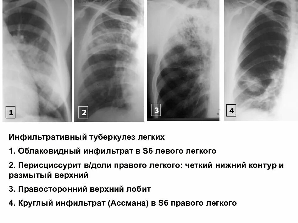 Округлый инфильтрат. Инфильтративный туберкулез рентгенография. Инфильтративный туберкулез рентген. Облаковидный инфильтративный туберкулез рентген. Инфильтративный туберкулез s6.