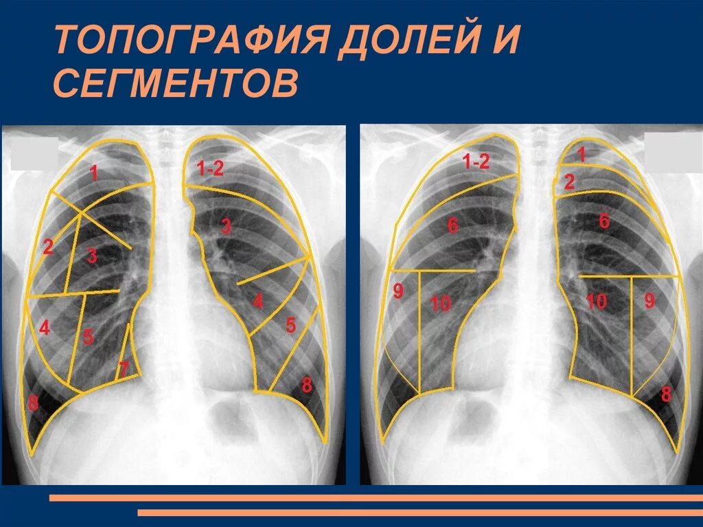 Сегменты лёгкого схема рентген. Сегментарное строение легких на рентгенограмме. Сегменты лёгких на рентгене. Сегменты правого легкого на рентгенограмме. Легкие в прямой проекции