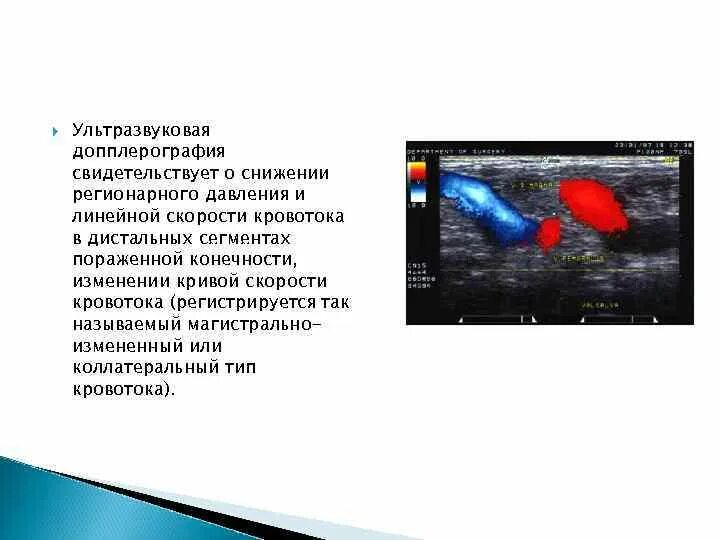 Кровоток не определяется. Снижение дистального кровотока. коллатеральный тип кровотока. допплерография нижних конечностей заключение. гангрена уздг описание.