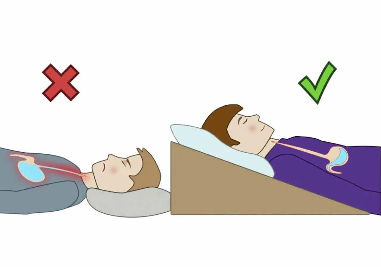 При рефлюксе на каком боку. Клиновидная подушка ГЭРБ. Клиновидная подушка для сна при ГЭРБ. Подушка при ГЭРБ. Подушка при рефлюкс эзофагите.