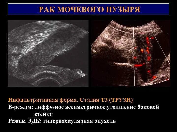 Опухоль мочевого пузыря в стадии т3:. Ультразвуковая анатомия мочевого пузыря. Утолщенные стенки мочевого пузыря. Трабекулярная стенка мочевого пузыря. Диффузное утолщение стенок