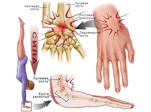 Повреждение лучезапястного сустава. Растяжение кисти в лучезапястном суставе. Болят лучевые кости почему