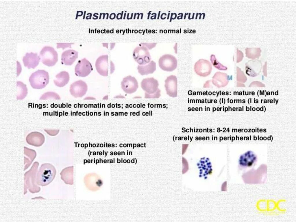 Стадии развития p falciparum обнаруживаемые при микроскопии. Plasmodium falciparum гаметоцит. малярия фальципарум. plasmodium falciparum на стадии кольца. плазмодий фальципарум.