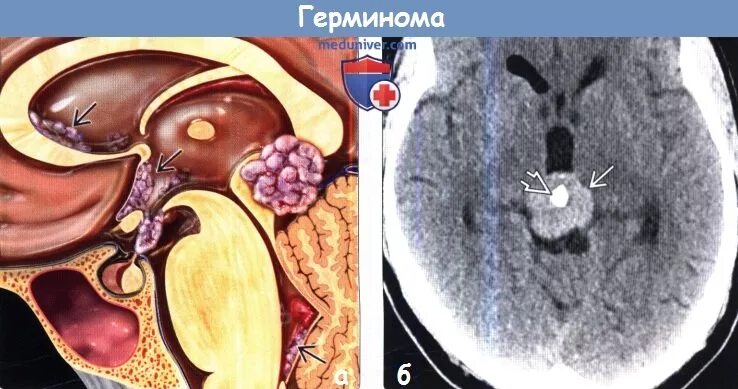 Герминома. Герминома воронки гипофиза. Герминома шишковидной железы кт. Герминома шишковидной железы мрт.