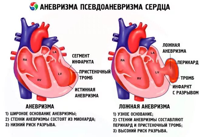 Аневризма сердца что это такое симптомы. Аневризма сердца (выпячивание истонченной стенки сердца). Аневризма верхушечная сердца. Хроническая аневризма сердца. Аневризма и инфаркт миокарда.