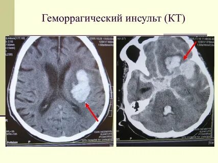 Кт при инсульте