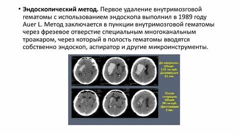 Операция при инсульте