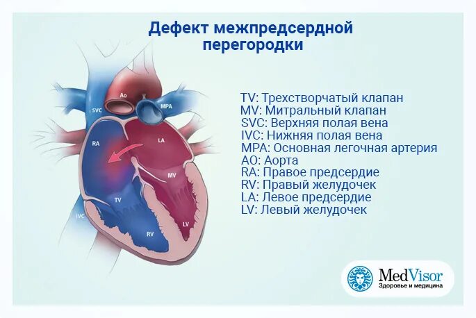 Врожденные пороки сердца дефект межпредсердной перегородки. Дмпп экг. рестриктивный дефект межпредсердной перегородки. дефект межпредсердной перегородки экг.